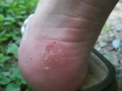 A blister