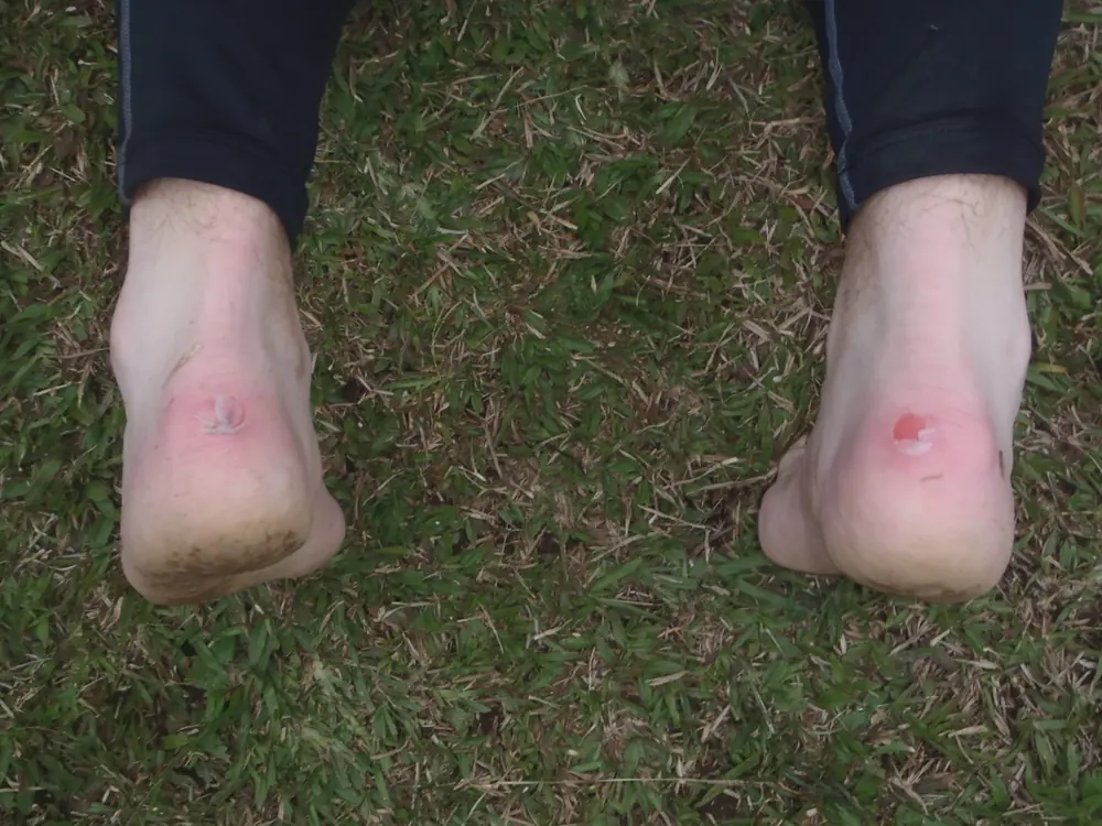 Blister care