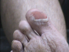 Ouch, a painful toe blister left too long without first aid.