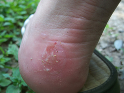 Typical heel blister which is painful